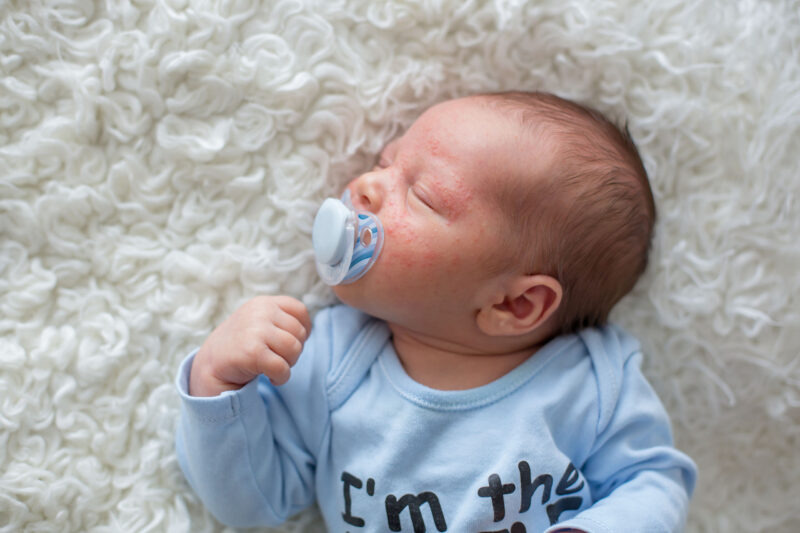 Baby mit Akne