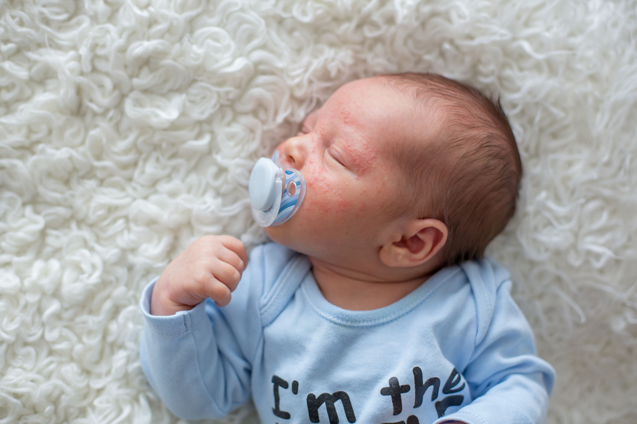 Baby mit Akne